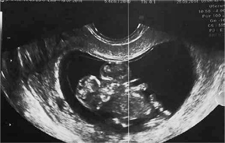 Ultrasound image of conjoined twins attached at the thorax.