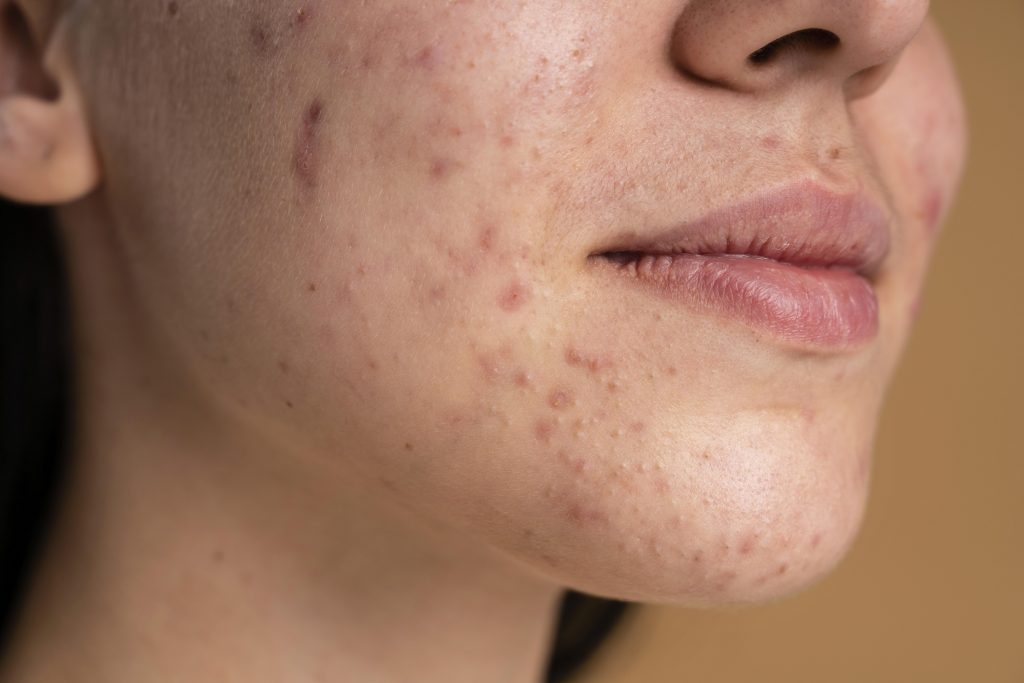 Acne 8 Acne closeup on the cheek and chin
