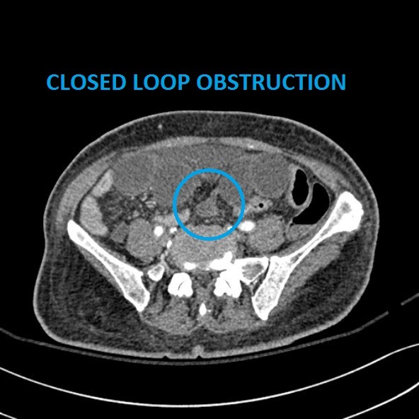 CT scan of the intestine showing closed loop obstruction.