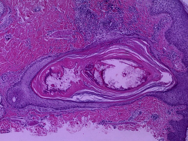 Histological sample of acneic skin and hair follicle