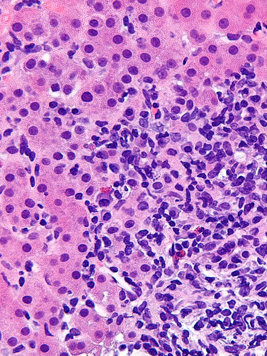 Biopsy sample of autoimmune hepatitis. Pink background with purple dots