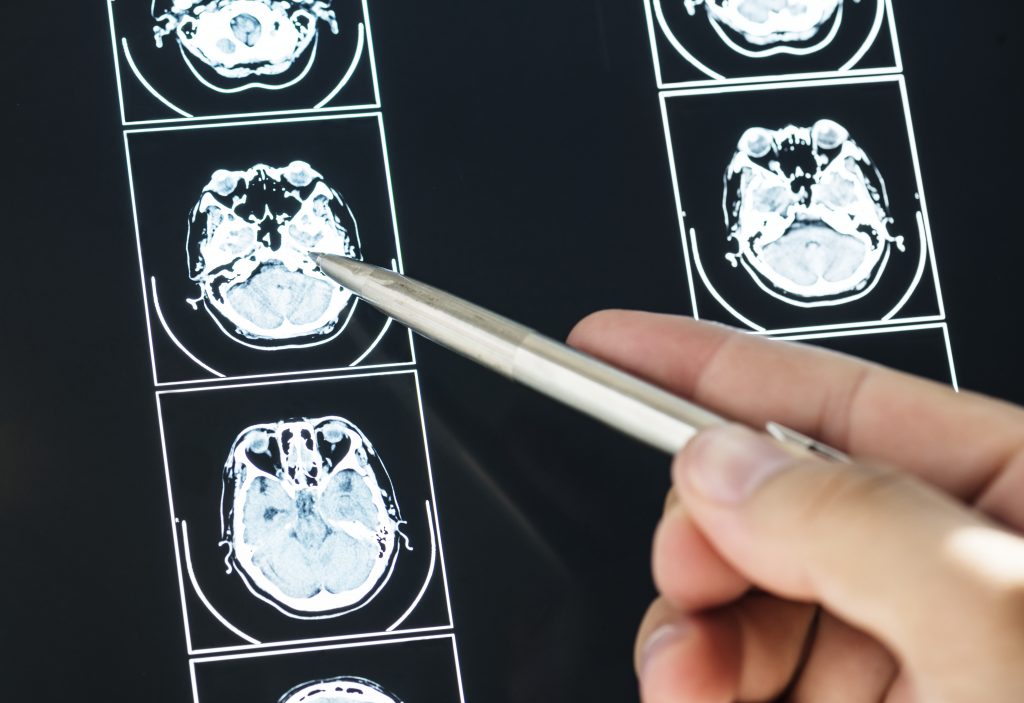 Concussion 4 brain MRI scan is used to diagnose concussion