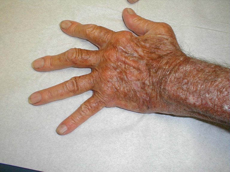 changes of rheumatoid arthritis