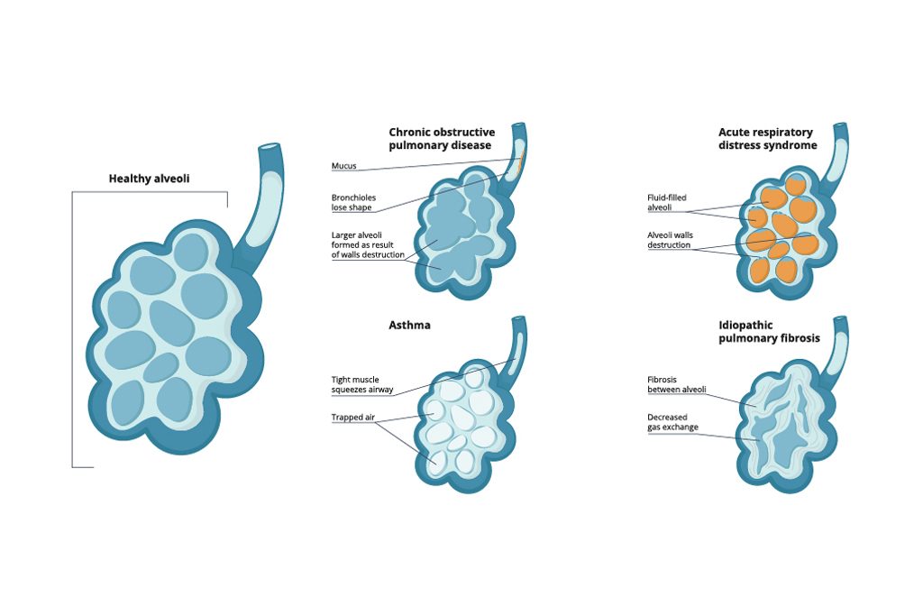 What Causes Acute Respiratory Distress Syndrome?