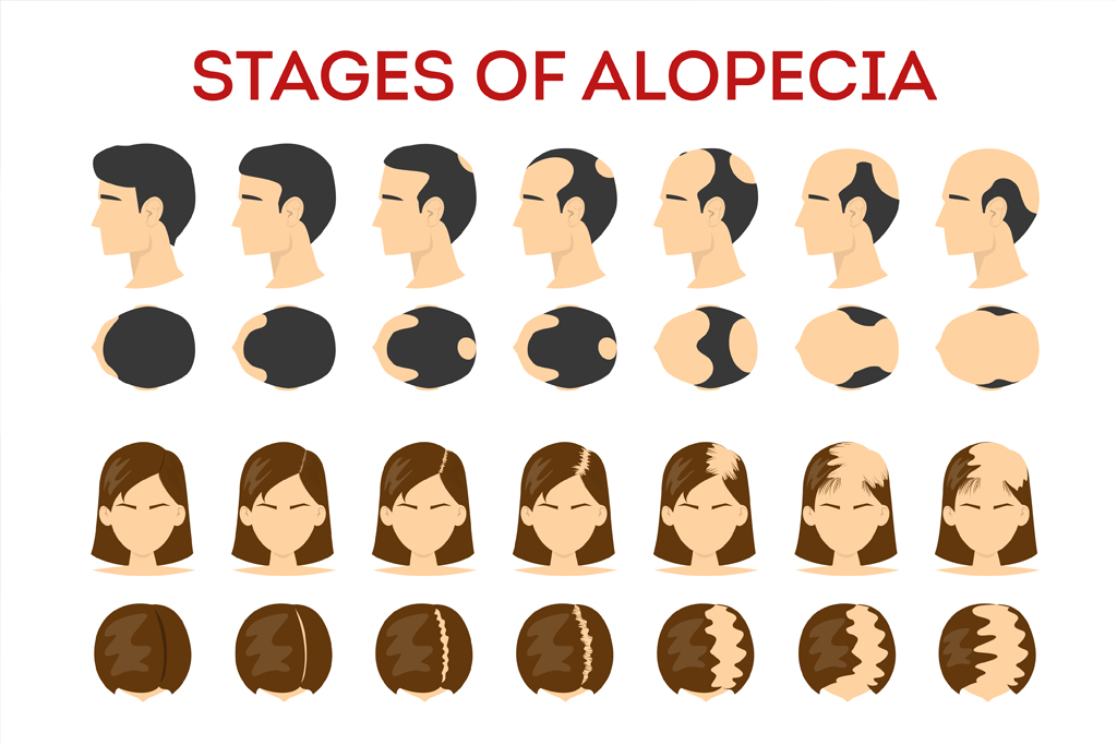 How Does My Doctor Know I Have Alopecia Areata?